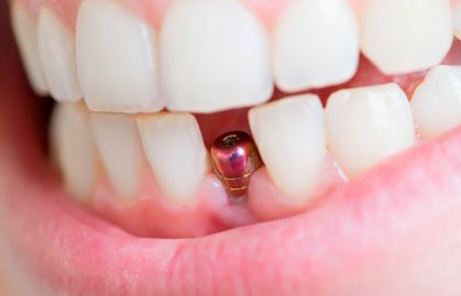 Implante dental 