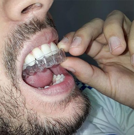 Dental Gallardo ortodoncia invisible