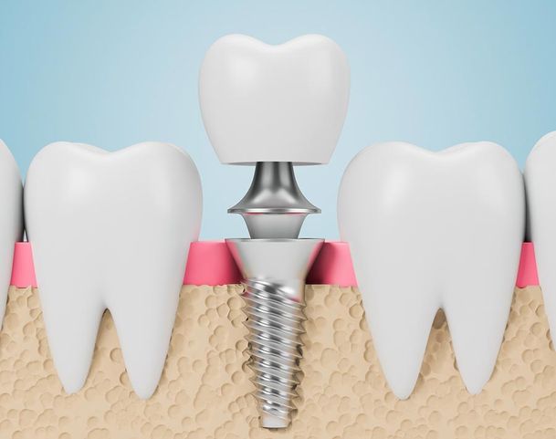 Implantes dentales