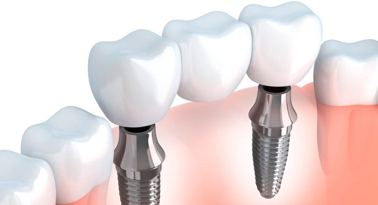 Representación de implante dental 