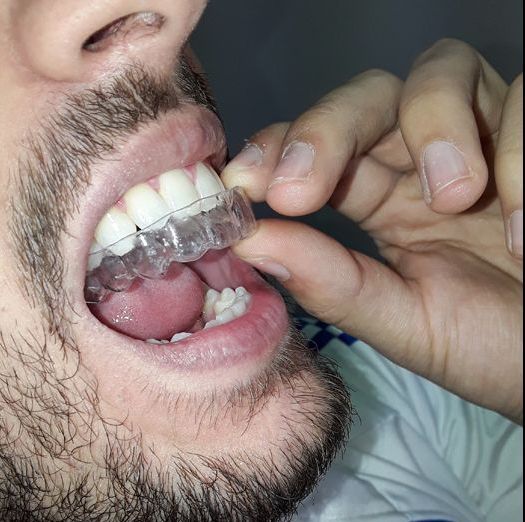 Dental Gallardo hombre con ortodoncia invisible